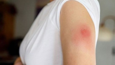 Bị áp xe vết tiêm: Nguyên nhân, dấu hiệu và cách điều trị