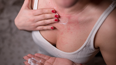 Bị dị ứng da nổi mẩn đỏ nguyên nhân là do đâu? Cách xử trí hiệu quả