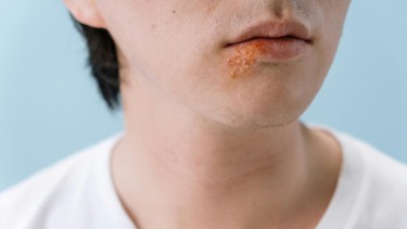 Bị giời leo ở miệng bôi gì để nhanh khỏi? Hướng dẫn điều trị và phòng ngừa