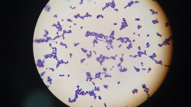 Bị nấm Candida có ảnh hưởng đến kinh nguyệt không? Khi nào cần đi khám phụ khoa?