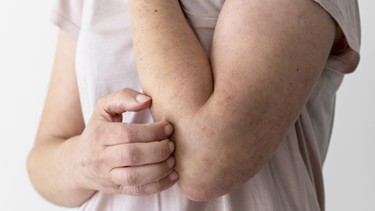 Bị ngứa khắp người: Nguyên nhân, triệu chứng và cách điều trị