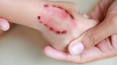 Bị người cắn có sao không? Khi nào cần đi khám ngay?