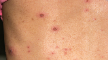 Bị thủy đậu có được ăn bún không? Ăn thế nào để không làm bệnh nặng hơn