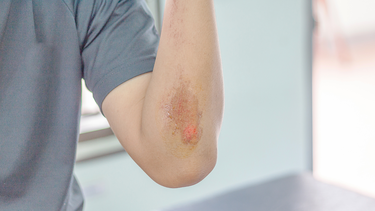 Bị trầy xước da nên ăn gì cho mau lành vết thương?