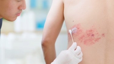 Bị zona thần kinh bôi gì? Cách lựa chọn thuốc bôi zona thần kinh theo từng trường hợp