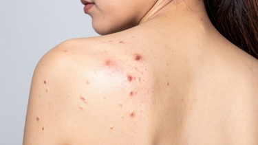 Bít tắc lỗ chân lông: Nguyên nhân, dấu hiệu và cách khắc phục