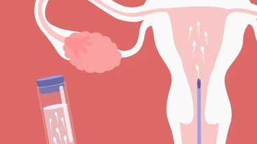 Bơm IUI chi phí bao nhiêu? Quy trình thực hiện IUI