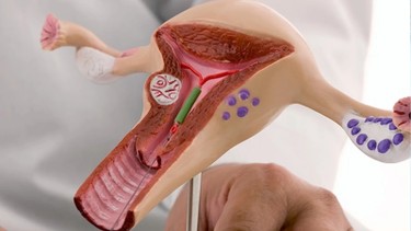 Bơm IUI là gì? Quy trình thực hiện và tỷ lệ thành công