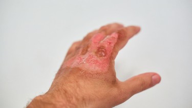 Bỏng cấp độ 3 là gì? Dấu hiệu nhận biết, cách xử trí và phục hồi đúng cách