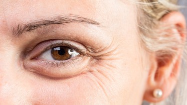 Bọng mắt là gì? Nguyên nhân, triệu chứng nhận biết và cách khắc phục 