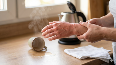 Bỏng nước sôi: Nhận biết, xử trí đúng và cách phòng ngừa