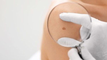 Bớt bẩm sinh: Nguyên nhân, dấu hiệu và cách điều trị