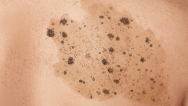 Bớt Spilus là gì? Đặc điểm, nguyên nhân và cách xử lý