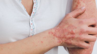 Các loại nấm da thường gặp và cách nhận biết sớm
