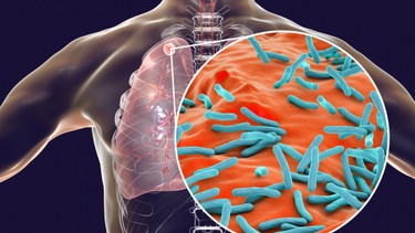 Cách chăm sóc bệnh nhân lao phổi giai đoạn cuối như thế nào?