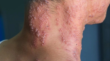 Cách chữa bệnh zona thần kinh biến chứng: Những điều bạn cần lưu ý