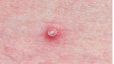Cách chữa mụn nhọt đầu đinh hiệu quả: Top 6 phương pháp an toàn nên áp dụng