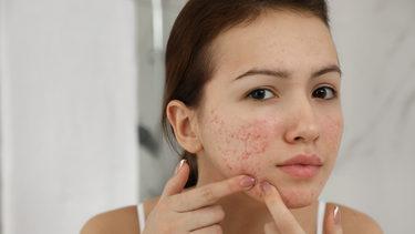 Cách chữa trị mụn nhọt ở mặt: Giải pháp hiệu quả giúp làn da khỏe mạnh