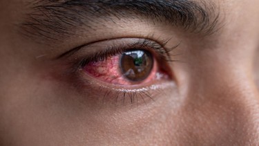 Cách điều trị đau mắt hột hiệu quả và an toàn