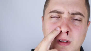 Cách sơ cứu chảy máu cam hiệu quả và các lưu ý quan trọng bạn cần biết