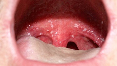 Cách trị bệnh nấm lưỡi ở người lớn an toàn và hiệu quả