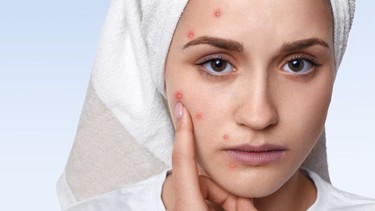 Cách trị mụn nội tiết​ hiệu quả và an toàn