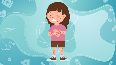 Cảnh giác với bệnh Rubella: Không chỉ là sốt phát ban thông thường!