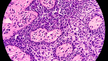 Carcinoma là gì? Nguyên nhân chính của ung thư carcinoma