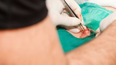 Cắt dây hãm bao quy đầu: Những điều nam giới cần biết trước khi thực hiện
