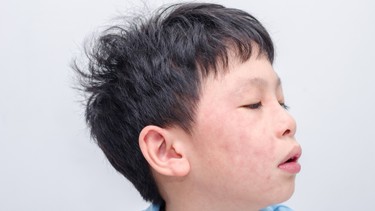 Chăm sóc trẻ phát ban sau sốt đúng cách để tránh biến chứng