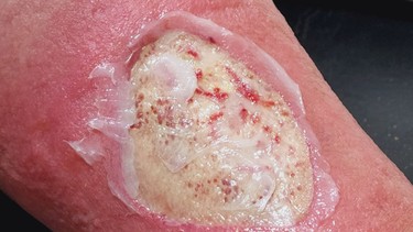 Chăm sóc vết loét tỳ đè đúng cách giúp hạn chế biến chứng