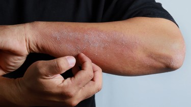 Chàm thể tạng: Nhận biết sớm, kiểm soát đúng cách và phòng tái phát lâu dài