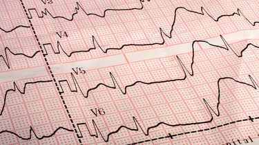 Chẩn đoán thiếu máu cơ tim cục bộ: Phương pháp và lưu ý cần biết