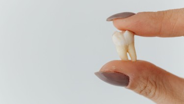 Chân răng khôn là gì? Răng khôn có mấy chân?