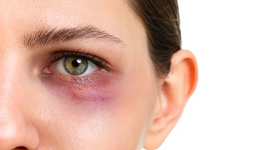 Chấn thương mắt: Nguyên nhân thường gặp và cách xử lý khẩn cấp