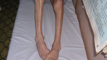 Chân vòng kiềng có chữa được không? Các phương pháp điều trị