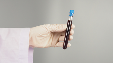 Chỉ số anti TPO cao có nguy hiểm không? Nguyên nhân làm tăng anti TPO