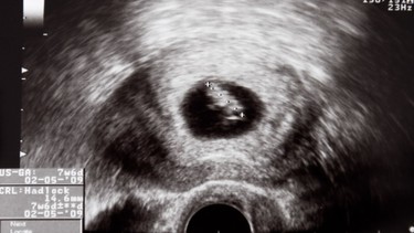 Chỉ số beta HCG thai 5 tuần là bao nhiêu? Những lưu ý cho mẹ bầu khi có thai ở tuần thứ 5