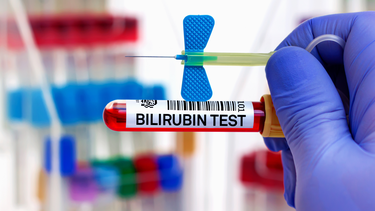 Chỉ số bilirubin trực tiếp có ý nghĩa gì trong chẩn đoán bệnh?