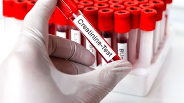 Chỉ số creatinin bao nhiêu thì phải chạy thận? Cảnh báo mức độ nguy hiểm và hướng xử lý
