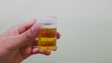 Chỉ số creatinin trong nước tiểu cao: Nguyên nhân, ý nghĩa và cách xử lý?