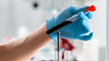 Chỉ số Cyfra 21-1 bao nhiêu là nguy hiểm​? Nguyên nhân Cyfra 21-1 tăng cao