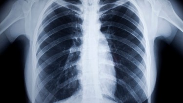 Chụp X-quang lưng bao nhiêu tiền? Những lưu ý trước khi chụp X-quang