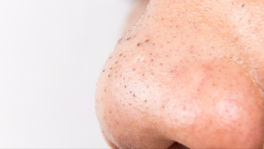 Có nên nặn mụn đầu đen không? Lý do và cách giảm mụn đầu đen