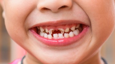 Có nên nhổ răng sữa bị sâu và khi nào là hợp lý?