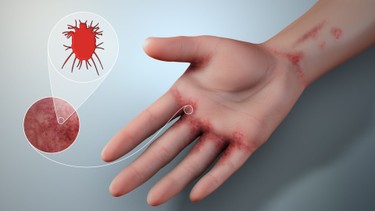 Con cái ghẻ chết ở nhiệt độ bao nhiêu? Cách diệt con cái ghẻ tại nhà hiệu quả