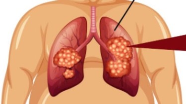Xạ trị ung thư phổi bao nhiêu tiền?