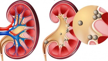 Các dấu hiệu sỏi thận​ thường gặp là gì? Phương pháp điều trị sỏi thận