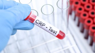 CRP là gì? Ý nghĩa và vai trò của xét nghiệm CRP trong chẩn đoán viêm