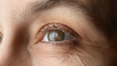 Cườm nước là gì? Nguyên nhân và cách điều trị